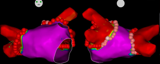 ablation index